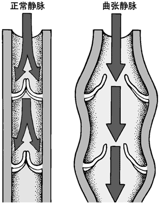 曲张静脉的瓣膜