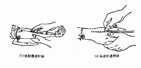 静脉注射操作方法