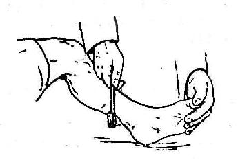 跟腱反射检查法示意图