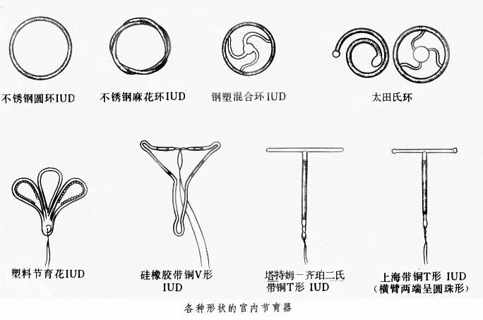 各种形状的官内节育器