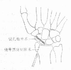 陈旧性舟骨骨折的手术治疗