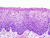 Cervical intraepithelial neoplasia (3) CIN2.jpg