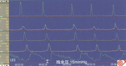 LES高压患者食管测压