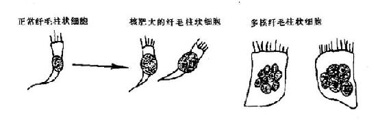 核肥大和多核纤毛柱状细胞示意图