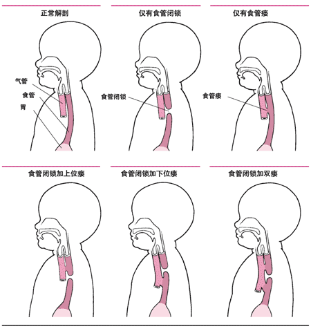 消化道畸形