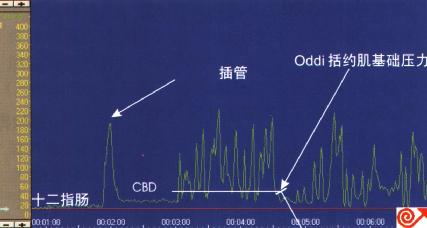 Oddi括约肌（SO）定点牵拉测压图