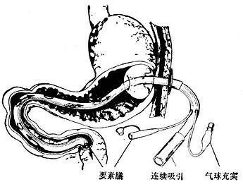 三腔鼻食道胃十二指肠气球管