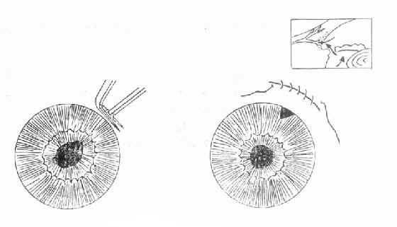周边虹膜切除术