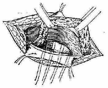 缝合联合肌腱与腹股沟韧带
