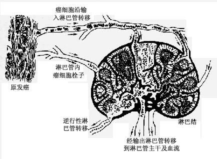 癌的淋巴道转移模式图