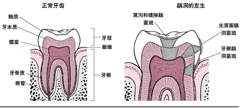 牙齿的龋洞