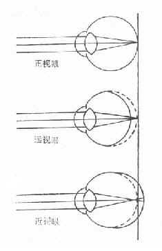 正视眼、远视眼、近视眼的屈光状态