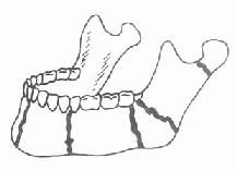 下颌骨骨折好发部位
