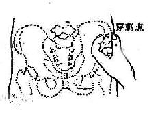 髂前上棘穿刺点