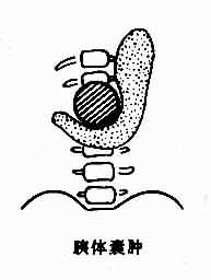 胰腺囊肿