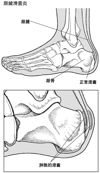 跟腱滑囊炎