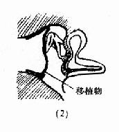 鼓室成形术