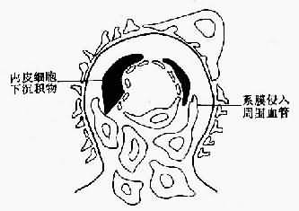 膜性增生性肾小球肾炎Ⅰ型示意图