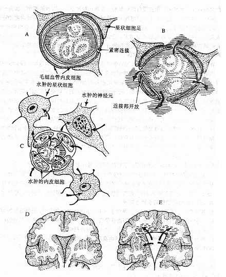 各类脑水肿发生机制示意图