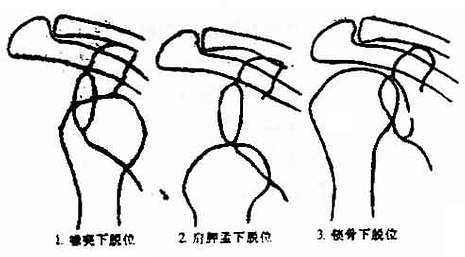 肩关节脱位