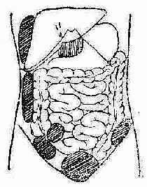 腹腔脓肿好发部位