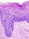 Cervical intraepithelial neoplasia (4) CIN3.jpg