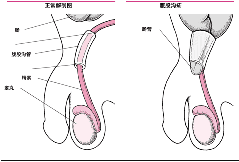 腹股沟疝