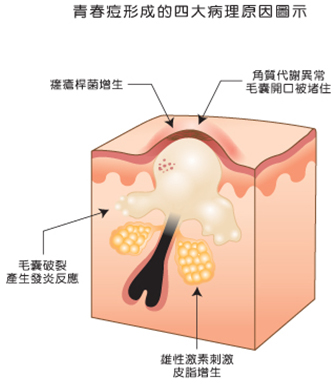 痤疮形成示意图