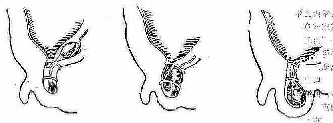 睾丸下降过程