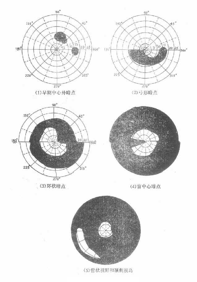 开角型青光眼的视野改变