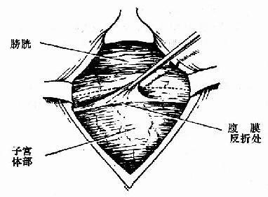 提起反折腹膜，沿虚线切开