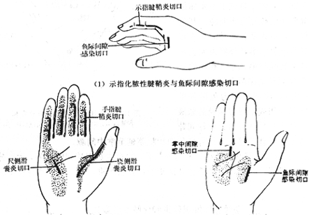 手屈指肌腱鞘炎、滑囊炎、手掌深部间隙感染的手术切口