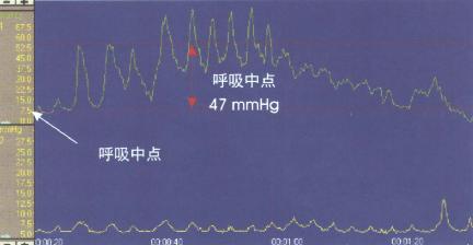 呼吸中点LES压力