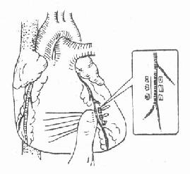 心脏裂口缝合法之二