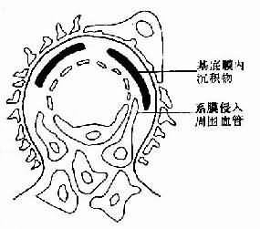 膜性增生性肾小球肾炎Ⅱ型示意图