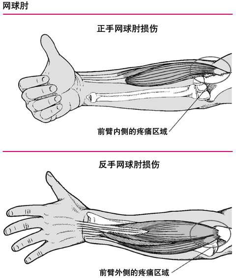 反手网球肘