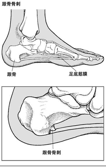 跟骨骨刺