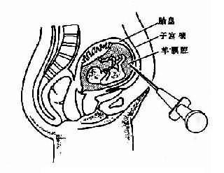 羊膜穿刺抽取羊水示注射器穿越腹壁到羊腔抽取羊水