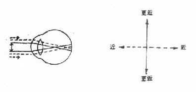 复性近视散光