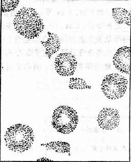 微血管病性溶血性贫血血片中能见到裂体细胞