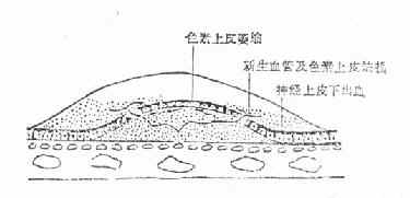 视网膜下新生血管