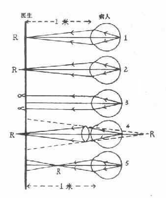 检影验光原理