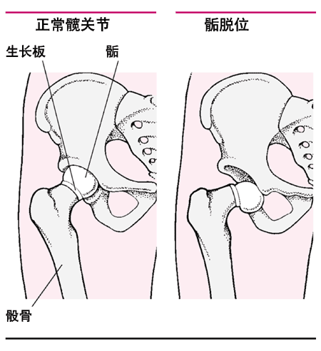 股骨头骨骺滑脱