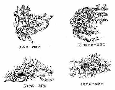 肠套迭的几种类型