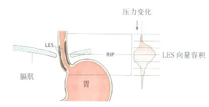 LES穿过膈肌示意图，LES压力轮廓用向量容积表示