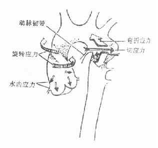 钝性损伤中引起主动脉破裂的各种应力作用