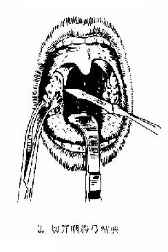 扁桃体切除术（剥离法）