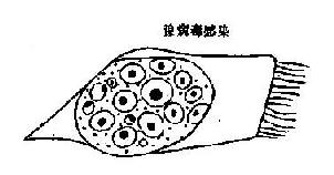 病毒感染时，痰涂片中的细胞内包涵体