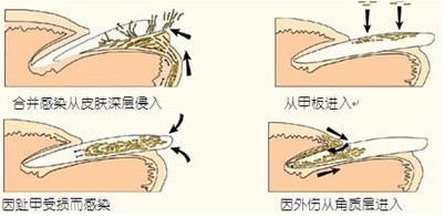 灰指甲是如何感染的