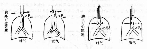 不同类型中央气道阻塞呼气与吸气时气道阻力变化